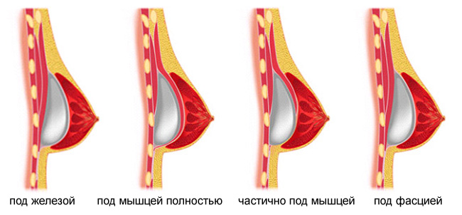 Фото Увеличения Груди Имплантами